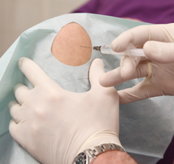 Hyalurons&auml;uretherapie